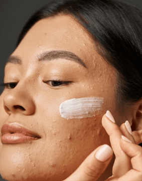Aichun Beauty - Acne Treatment Gel